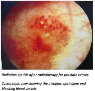 radiation-cystitis